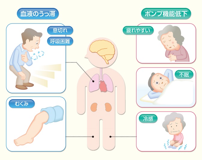 心不全 症状 部位から診療科を探す 済生会横浜市南部病院