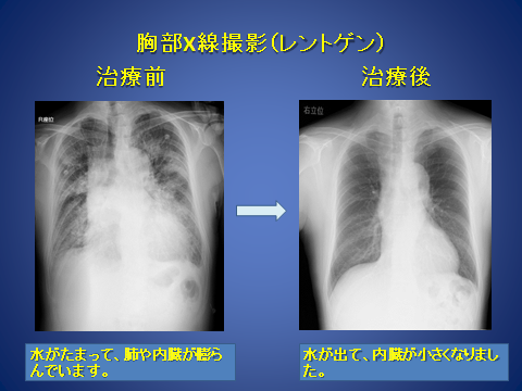 心不全 症状 部位から診療科を探す 済生会横浜市南部病院