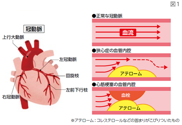 狭心症・心筋梗塞（冠動脈疾患） | 症状・部位から診療科を探す ...