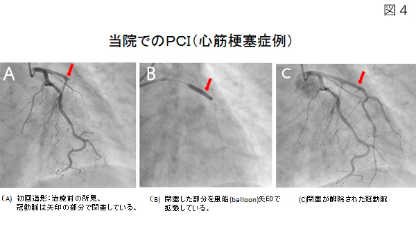 狭心症・心筋梗塞（冠動脈疾患） | 症状・部位から診療科を探す ...