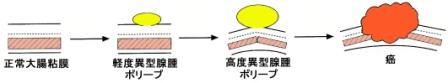 ポリープからがんへ