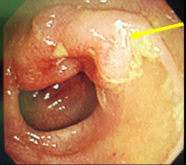 大腸がん大腸カメラ