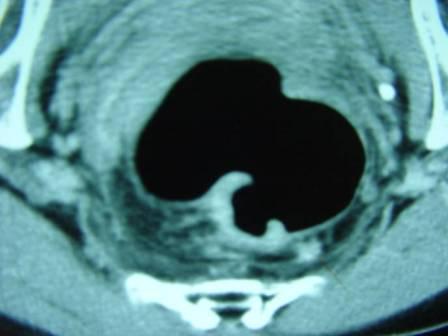 大腸がんCT画像