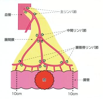 花嫁 大腸癌 ステージ4