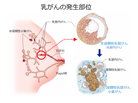 転移 乳がん リンパ