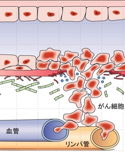 転移 乳がん リンパ