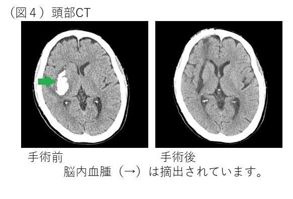 神経内視鏡手術 | 診療科・部門 | 済生会横浜市南部病院